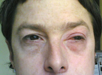 Mann mit Augeninfektion