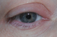 Verquollenes Auge - Nahaufnahme